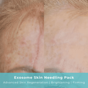 Exosome Skin Needling Image