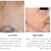 Exosome Skin Needling Before and After