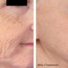 Exosome Skin Needling Comparison image
